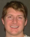 Ceramic facets - veneers - Photo before - Dr. Jonathan Penchas DMD