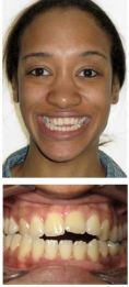 Other cosmetic and aesthetic dentistry - Photo before - Dr. William W. Roberts III D.M.D.