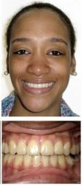 Other cosmetic and aesthetic dentistry - Photo before - Dr. William W. Roberts III D.M.D.