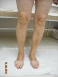 Sclerotization of varicose veins - Photo before - dr n. med. Andrzej Popow