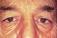 Eyelid surgery (Blepharoplasty) - Photo before - Klinika Laser Esthetic