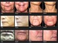 Anti-Aging - Vorher Foto - Dr. med. Alain Tenenbaum