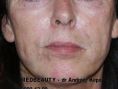 Facelift, SMAS Facelift - Vorher Foto - dr Andrzej Kępa