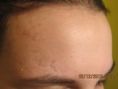 Scar removal - Photo before - Klinika Laser Esthetic