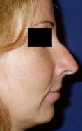 Rhinoplasty (Nose Job) - Photo before - Klinika Laser Esthetic