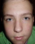 Laser acne treatment - Photo before - Klinika Laser Esthetic