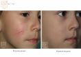 Laser Scar Treatment - Photo before - Dr n. med. Marcin Bieńkowski