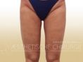 Thigh Lift Surgery - Photo before - Dr. med. Gunther Arco