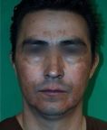 Fotorejuvenecimiento (IPL) - rejuvenecimiento de la piel - Foto Antes de - Dr. Aristides Arellano-Huacuja