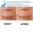 Injections de comblement - Les plis d