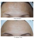 Age Spots Treatment - Photo before - Dr n. med. Marcin Bieńkowski