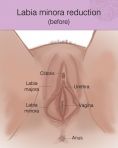 Labiaplasty (Labia Reduction) - Photo before - Dr Jayson Oates