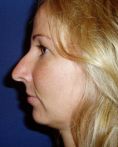 Rhinoplasty (Nose Job) - Photo before - Klinika Laser Esthetic