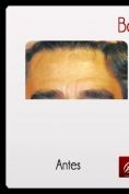 Botox/Dysport - Eliminar arrugas - Foto Antes de - Dr. Aristides Arellano-Huacuja