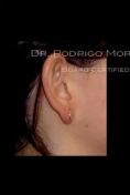 Ear surgery (Otoplasty) - Photo before - Dr. Rodrigo Morales De la Cerda