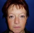 Eyelid surgery (Blepharoplasty) - Photo before - Klinika Laser Esthetic
