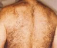 Laser hair removal - Photo before - Klinika Laser Esthetic