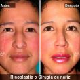 Cirugía de la nariz (Rinoplastia) - Paciente con nariz grande y Rinocifosis después de la rinoplastia vemos una nariz natural armónica al rostro mejorando el perfil
