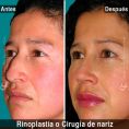 Cirugía de la nariz (Rinoplastia) - Paciente con nariz grande y Rinocifosis después de la rinoplastia vemos una nariz natural armónica al rostro mejorando el perfil