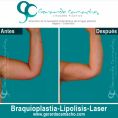 Body lifting - Foto Antes de - Dr. Gerardo Camacho