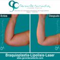 Body lifting - Foto Antes de - Dr. Gerardo Camacho