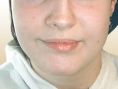 Rhinoplasty (Nose Job) - Photo before - Dr. med. Gunther Arco