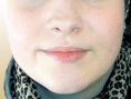Rhinoplasty (Nose Job) - Photo before - Dr. med. Gunther Arco