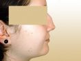 Rhinoplasty (Nose Job) - Photo before - Dr. med. Gunther Arco