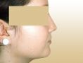 Rhinoplasty (Nose Job) - Photo before - Dr. med. Gunther Arco