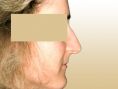 Rhinoplasty (Nose Job) - Photo before - Dr. med. Gunther Arco
