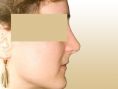 Rhinoplasty (Nose Job) - Photo before - Dr. med. Gunther Arco