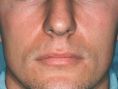 Rhinoplasty (Nose Job) - Photo before - Dr. med. Gunther Arco
