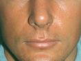 Rhinoplasty (Nose Job) - Photo before - Dr. med. Gunther Arco