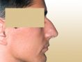 Rhinoplasty (Nose Job) - Photo before - Dr. med. Gunther Arco
