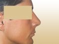 Rhinoplasty (Nose Job) - Photo before - Dr. med. Gunther Arco