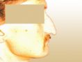 Rhinoplasty (Nose Job) - Photo before - Dr. med. Gunther Arco