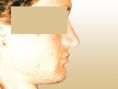 Rhinoplasty (Nose Job) - Photo before - Dr. med. Gunther Arco