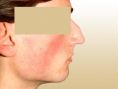 Rhinoplasty (Nose Job) - Photo before - Dr. med. Gunther Arco