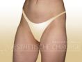 Thigh Lift Surgery - Photo before - Dr. med. Gunther Arco