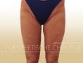 Thigh Lift Surgery - Photo before - Dr. med. Gunther Arco