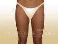 Thigh Lift Surgery - Photo before - Dr. med. Gunther Arco