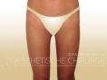 Thigh Lift Surgery - Photo before - Dr. med. Gunther Arco