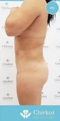 Liposukcia vodným lúčom (body-jet, Water-jet, WAL) - Fotka pred - Chirkoz Medical Clinic
