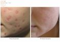Laser Scar Treatment - Photo before - Dr n. med. Marcin Bieńkowski