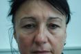 Eyelid surgery (Blepharoplasty) - Photo before - Prim. dr. sc. Davor Džepina