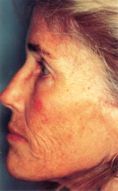 Mesotherapy (face, neck revitalization) - Photo before - Klinika Laser Esthetic