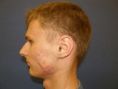 Laser acne treatment - Photo before - Klinika Laser Esthetic