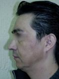 Fotorejuvenecimiento (IPL) - rejuvenecimiento de la piel - Foto Antes de - Dr. Aristides Arellano-Huacuja