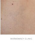Tattoo removal - Photo before - Bieńkowscy Clinic®