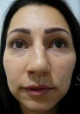 Septoplasty - Photo before - Dr. med. Jozefina Skulavik